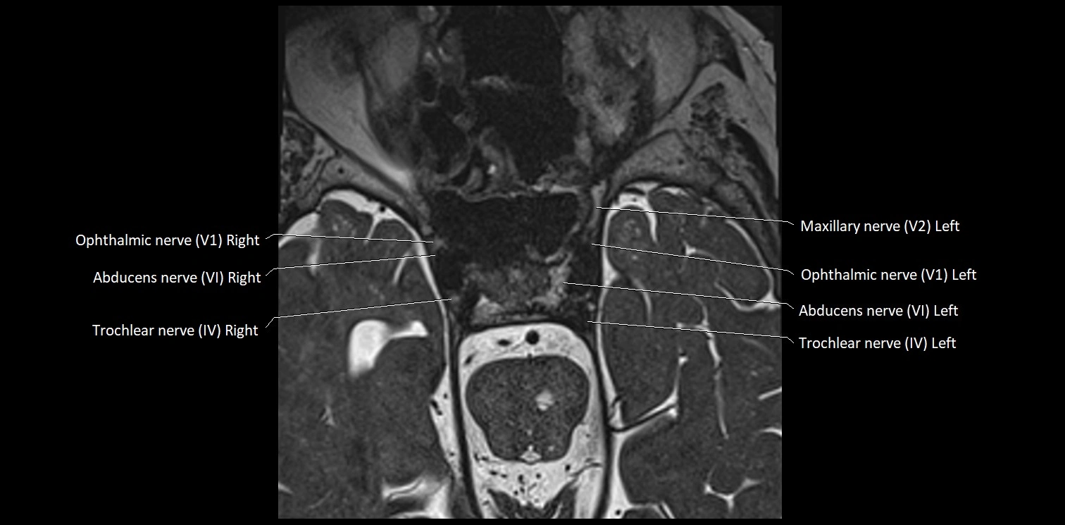 Cranial nerve anatomy axial MRI 3T image 30.webp